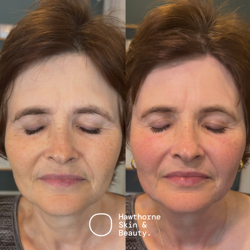 Want to lift & scuplt your face?
