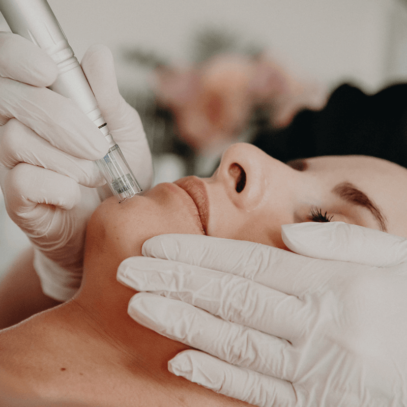Skin Needling